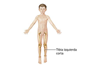 tratamiento pie plano